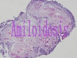 Amiloidosis
Fisiopatologia

Depésitos extracelulares de proteina fibrilar

AL amiloidosis primaria o asociada a mieloma
AA amiloidosis secundaria asociada a infeccion/ inflamacion cronica
B2 microglobulina amiloidosis secundaria a hemodialisis

Afectacion de intestino delgado 70% (mas frec en AL)

Anatomia patologica

Depésitos de amiloide perivasculares en lamina propia, submucosa y
entre fibras de capa muscular

Clinica
Malabsorcién, sangrado Gl, alteraciones de la motilidad, obstruccion

~ Diagnostico
biopsia rectal o yeyunal