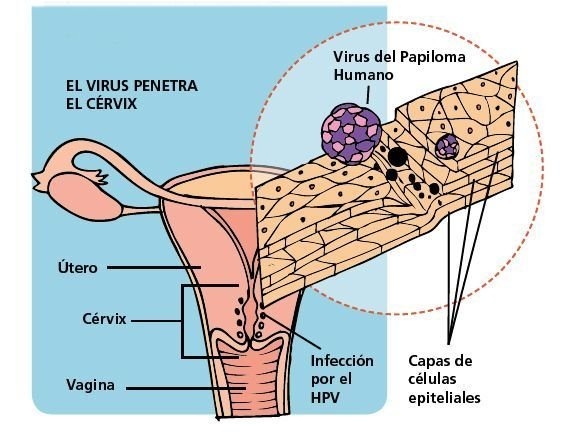 Virus del Paprloma

 
    
 
 
 

EL VIRUS PENETRA
EL CERVIX

   

Infecion Capa de
por al celulas
HPV epitehales