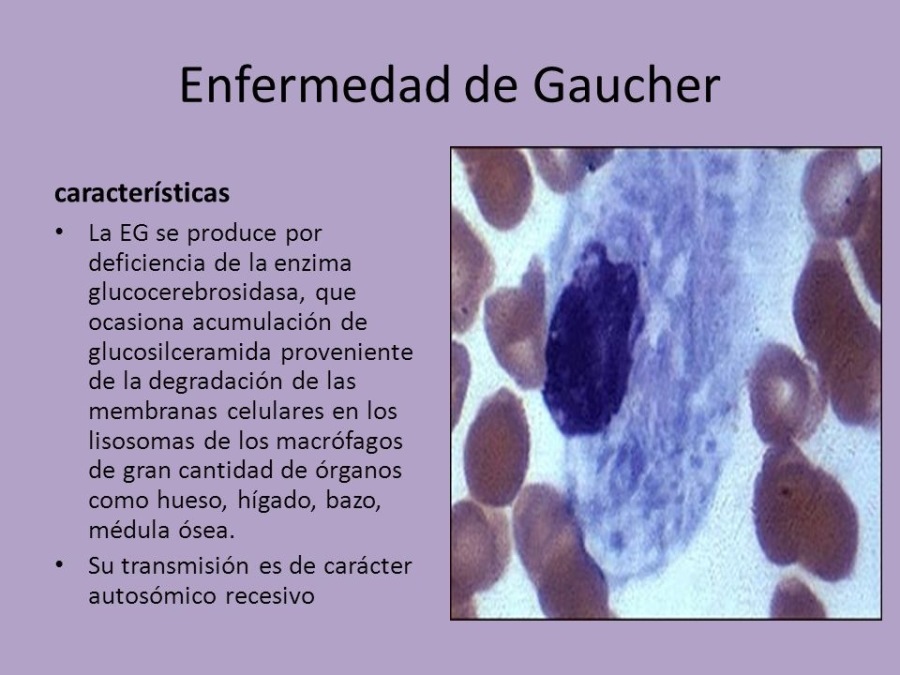 Enfermedad de Gaucher

caracteristicas

* La EG se produce por
deficiencia de la enzima
glucocerebrosidasa, que
ocasiona acumulacion de
glucosilceramida proveniente
de la degradacion de las
membranas celulares en los
lisosomas de los macrofagos
de gran cantidad de érganos
como hueso, higado, bazo,
meédula osea.

* Su transmision es de caracter
autosémico recesivo