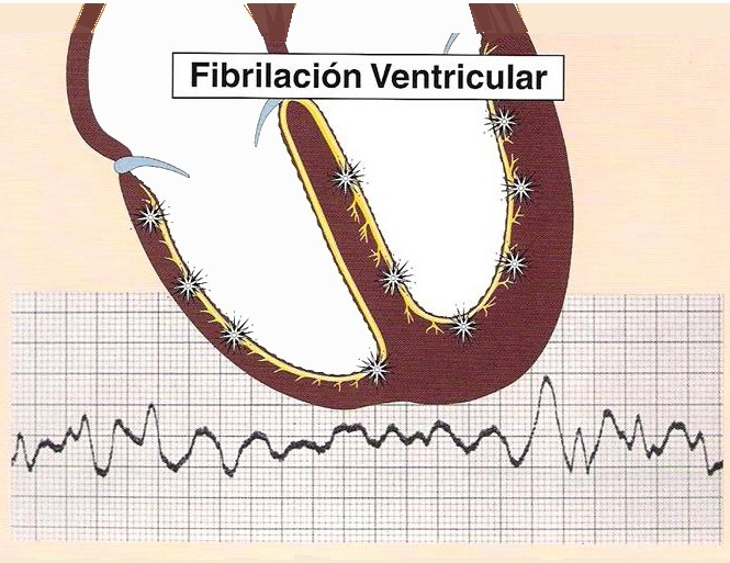 Fibrilacién Ventricular |