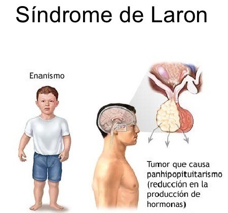 Sindrome de Laron

Fyn

Tumor que causa
panhipopttuttarismo
{reduccion en la
produccion de
hormonas)
