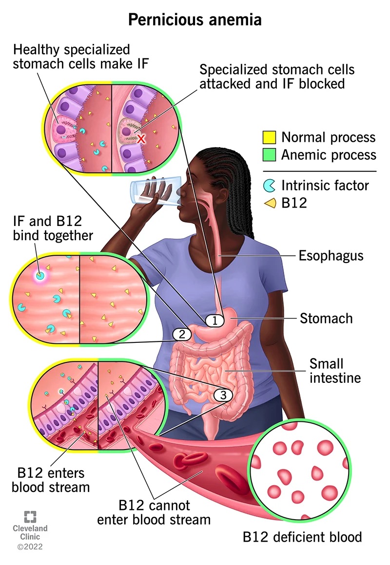 Pernicious anemia

Healthy specialized

stomach cells make IF Specialized stomach cells
attacked and IF blocked

  
   
   
   

[C1 Normal process
[1 Anemic process

 

(2 Intrinsic factor
<) B12

IF and B12
bind together

  
 
 
 
 
  
  
 
 

Esophagus

— Stomach

Small
intestine

B12 enters
blood stream

o B12 cannot
*d enter blood stream

emer B12 deficient blood

2022
