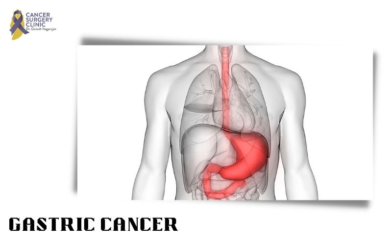 GASTRIC CANCER