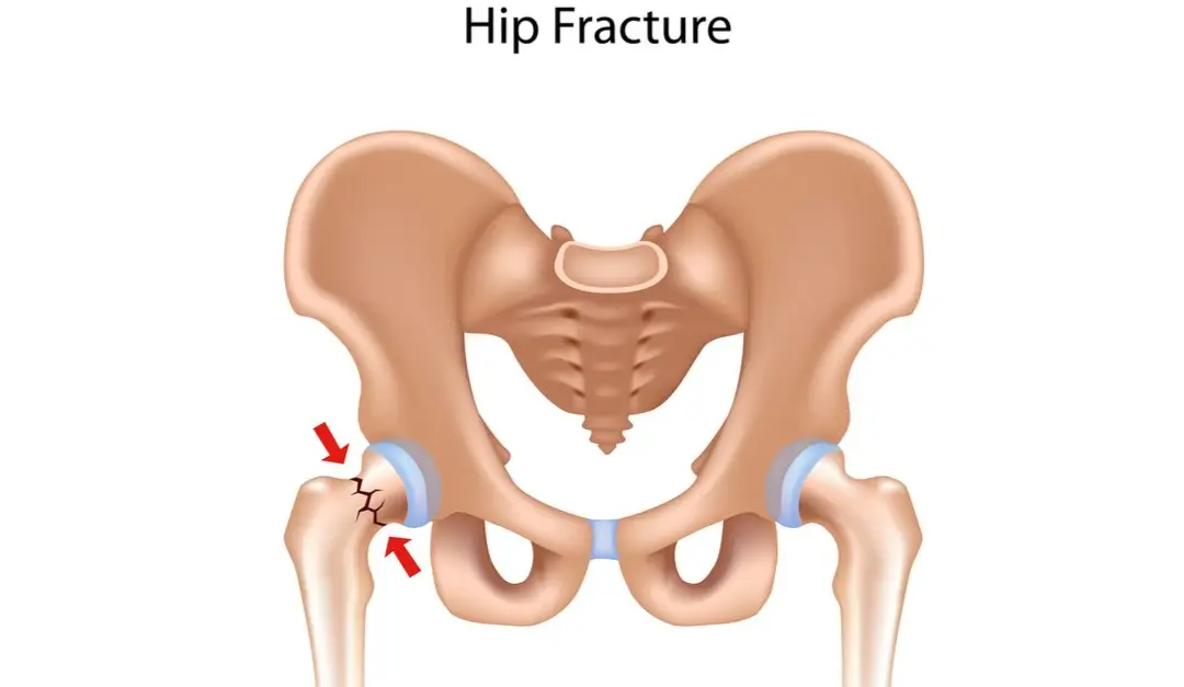Hip Fracture