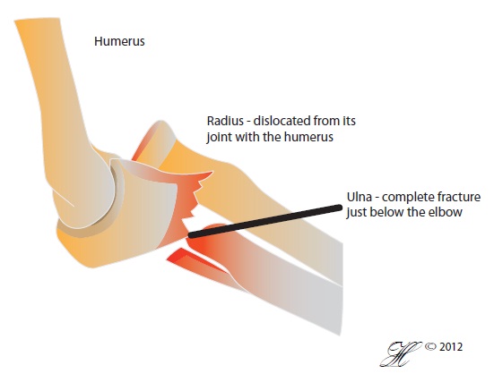 Radius disioc ated from its
Joint with the humerus.
Una complete fracture
Just bedow the elbow
Fo