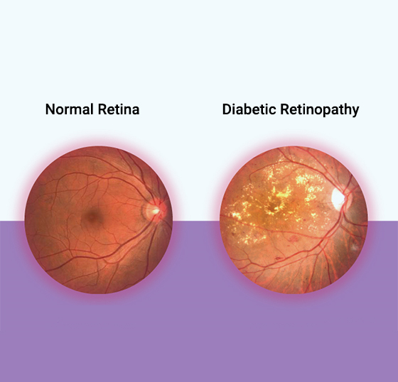 Normal Retina Diabetic Retinopathy