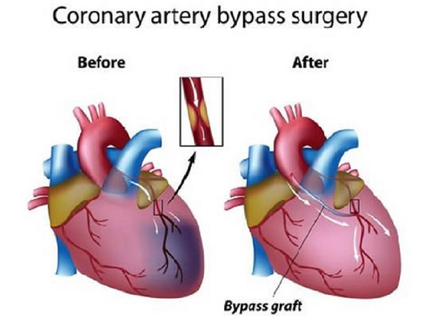 Coronary artery bypass surgery

Before After

\l

     

Bypass graft
