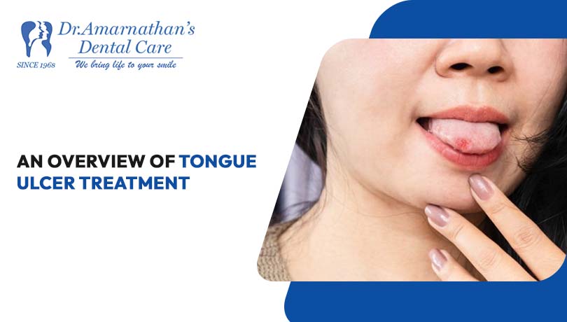 }) DrAmarnathan’s
Dental C
Wa log

 
 

AN OVERVIEW OF TONGUE
ULCER TREATMENT