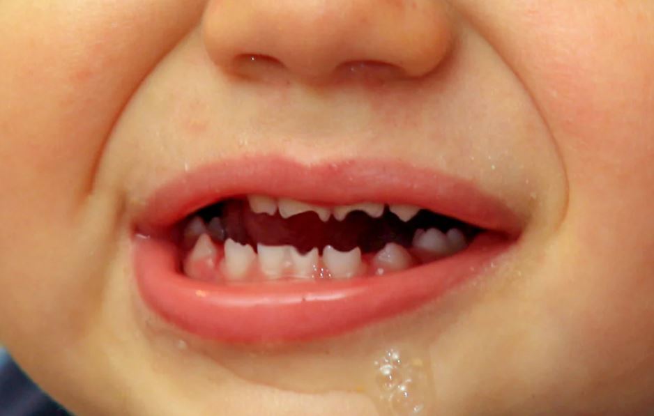 7M Dr.Amarnathan’s
1.1 Dental Care

  
 

WHAT EVERY PARENT
SHOULD KNOW ABOUT
HUTCHINSON'S TEETH?