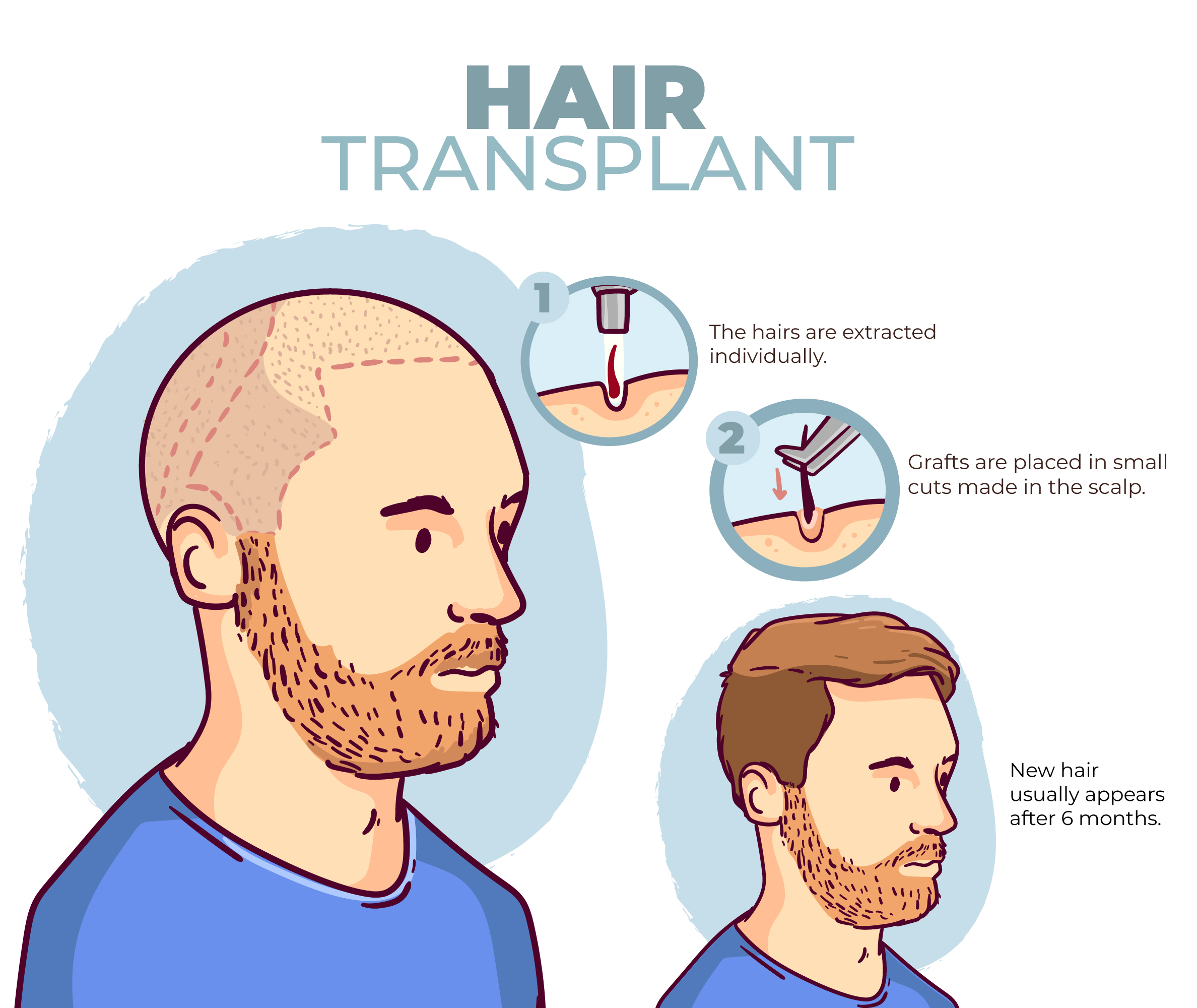 HAIR
TRANSPLANT

The hairs are extracted

individually.
Grafts are placed in small
) cuts made in the scalp.

New hair
usually appears
after 6 months.