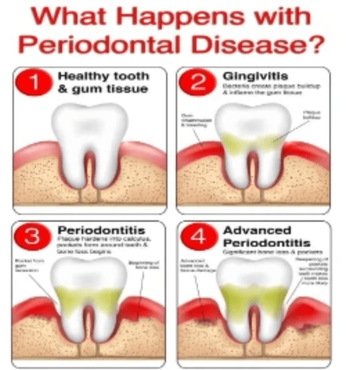 What Happens with
Periodontal Disease?

Sra -