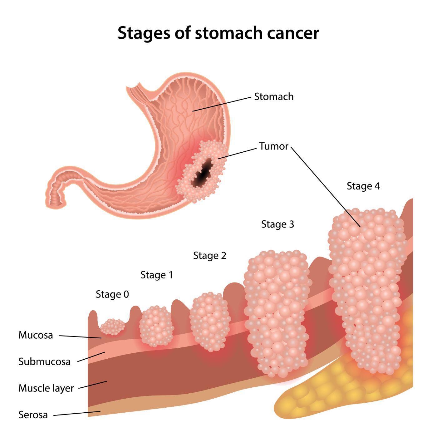 Stages of stomach cancer

  
 
  
 
 

Mucosa
Submucosa
Muscle layer

Serosa