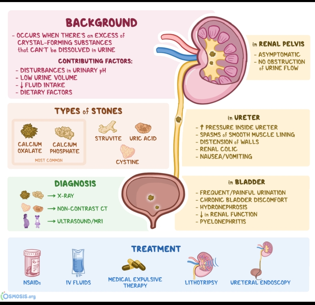 BACKGROUND

- OCCURS WHEN THERE'S an EXCESS of

CRYSTAL-FORMING SUBSTANCES in RENAL PELVIS

 

that CAN'T be DISSOLVED in URINE J
CONTRIBUTING FACTORS: - NO OBSTRUCTION
- DISTURBANCES in URINARY pH of URINE FLOW
= LOW URINE VOLUME
- | FLUID INTAKE
- DIETARY FACTORS
TYPES of STONES / (
° in URETER
£5 @ “{ - 1 PRESSURE INSIDE URETER
or - SPASMS of SMOOTH MUSCLE LINING
eG engi | SWE Gases ~ DISTENSION of WALLS
- RENAL COLIC

OXALATE PHOSPHATE
- NAUSEA/VOMITING

 

 

DIAGNOSIS in BLADDER

5 - FREQUENT/PAINFUL URINATION
®D — xr - CHRONIC BLADDER DISCOMFORT

@ — NON-CONTRAST CT - HYDRONEPHROSIS

= - | in RENAL FUNCTION
b I — urrasouno/mri - PYELONEPHRITIS
TREATMENT BD
SR {
REDICA BEX ASE LITHOTRIPSY URE TERAL ENDOSCOPY

 

IV FLUIDS THERAPY