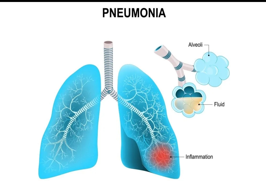 PNEUMONIA

Inflammation