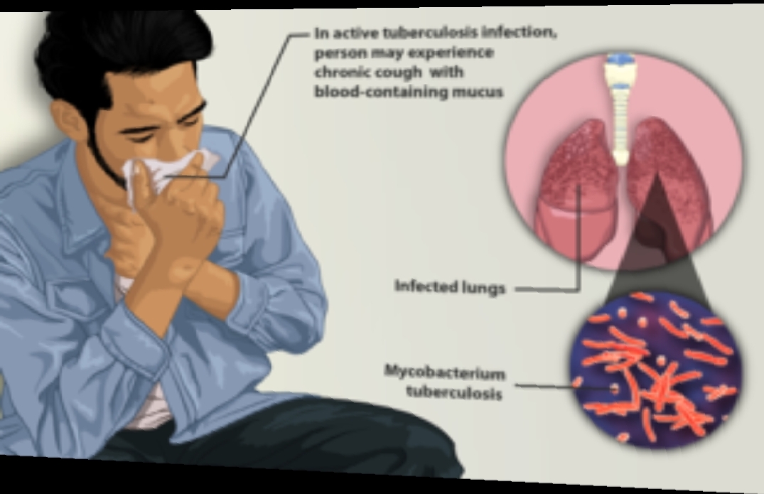 In active Tuber ubous ded tion
person may experience

chrome cough with

blood containing mucus

Infected lungs

Mycobacterium
tuberculosis