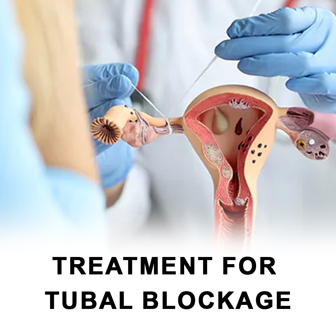 TREATMENT FOR
TUBAL BLOCKAGE