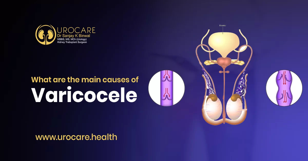 0
What are p= main causes of Cl)
Varicocele A

www.urocare.health