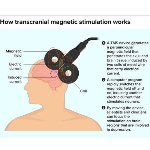 How transcranial magnetic stimulation works

© A TS device generates
o perpendcule:

Wagnenic magnet bed at
re penetrates the sku anc
brain tissue, induced by
Bectrc - two cots of metal wire
current that carry electrical
current
pepe © A compre program

(apuny swaches the
ragnenc bed of ang
on. ducing anatier
sect current that
Stimsates neurons.

© By moving the device.
scientists ana chracans
can focus the
maton on bean
regrons that are invotved
in Gepreusion

Con
