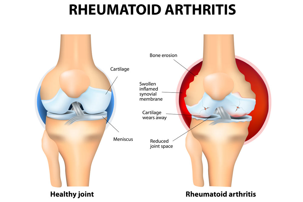 RHEUMATOID ARTHRITIS

Bone erosion

Cartilage

A inflamed
/ synovial
membrane
~— S\N Cartilage

wears away

 

Meniscus Reduced
joint space

Healthy joint Rheumatoid arthritis